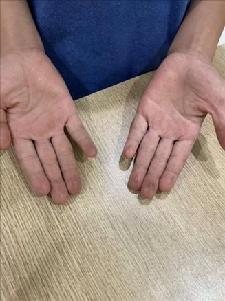 9歲小學(xué)生長期拍煙卡，手部粗糙長繭。受訪者供圖